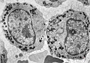 M,80y. | blood - myeloid leukemia